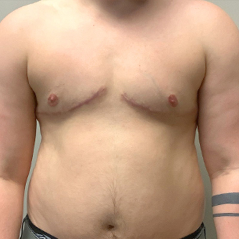 Female To Male Top Surgery 100