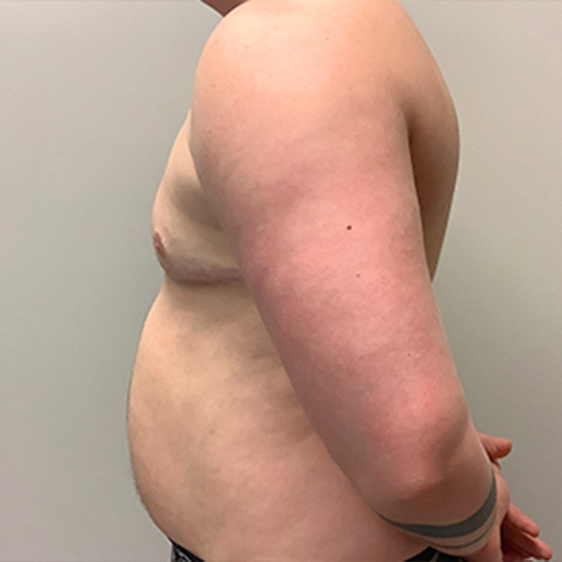 Female To Male Top Surgery 05