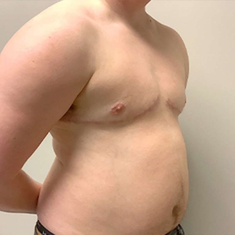 Female To Male Top Surgery 07