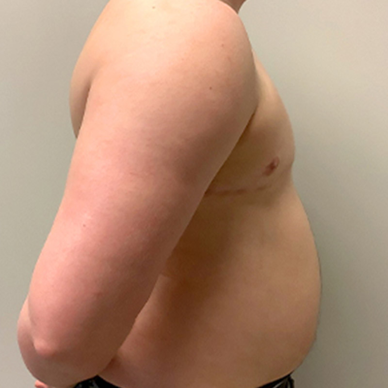 Female To Male Top Surgery 09