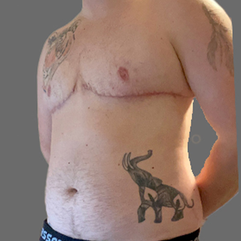 Female To Male Top Surgery 03