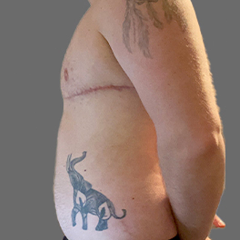 Female To Male Top Surgery 05