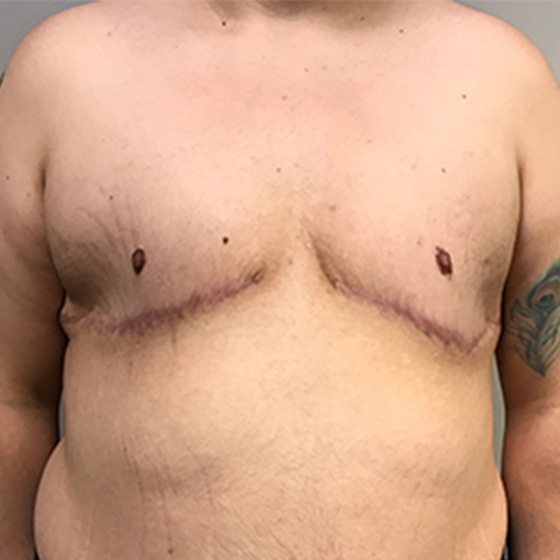 Female To Male Top Surgery 102