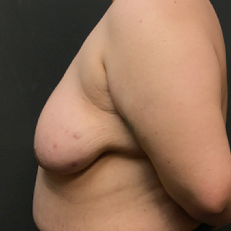 Female To Male Top Surgery 03