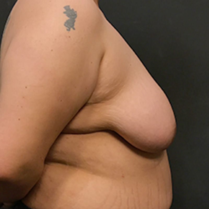 Female To Male Top Surgery 05