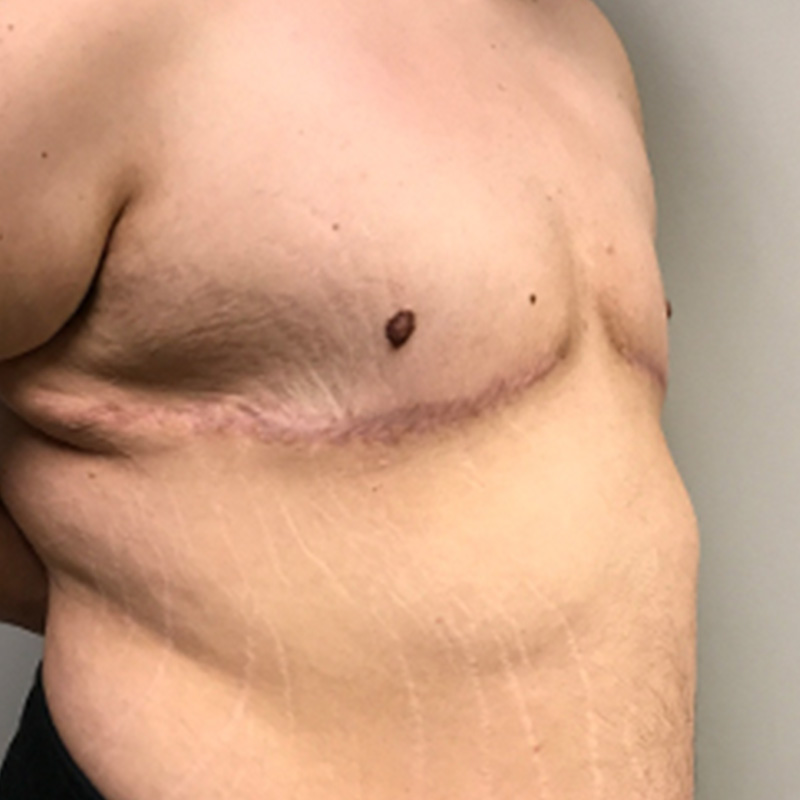 Female To Male Top Surgery 07