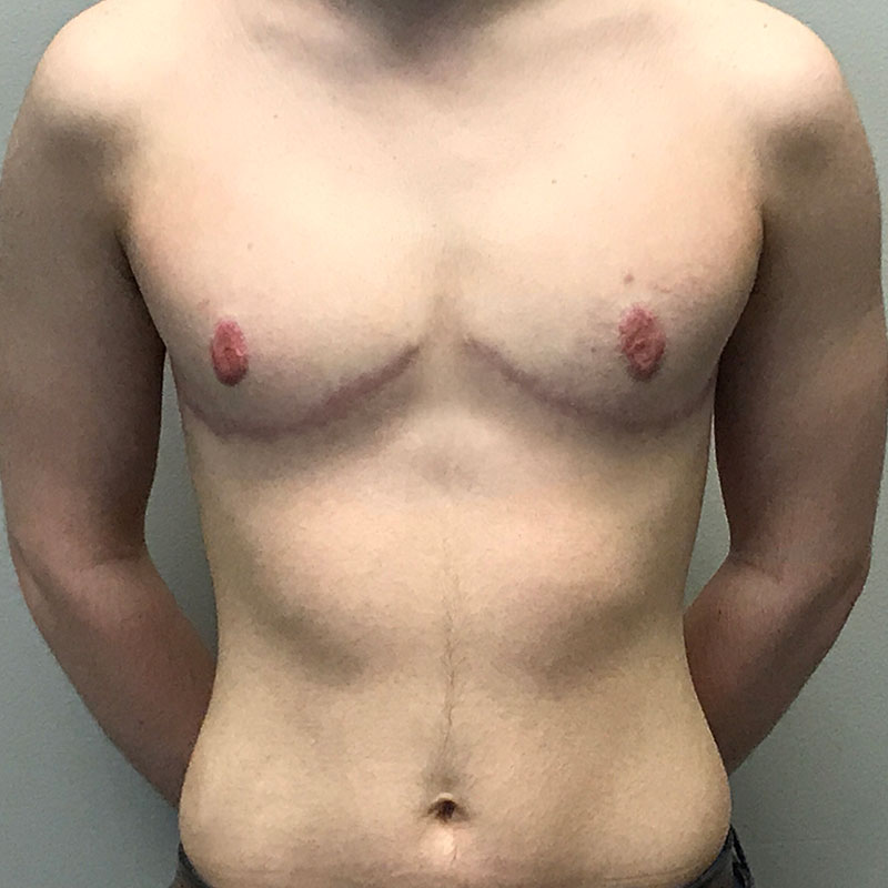 Female To Male Top Surgery 103