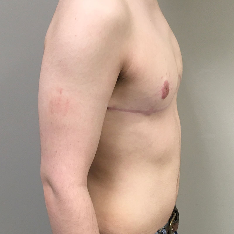 Female To Male Top Surgery 09