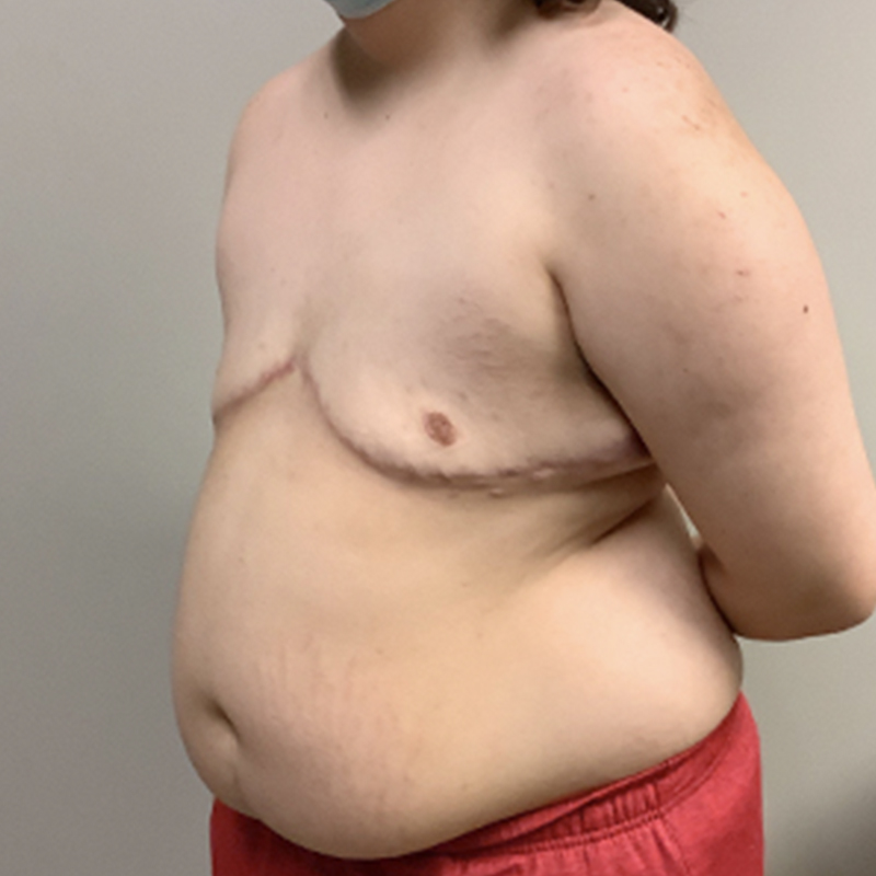 Female To Male Top Surgery 03