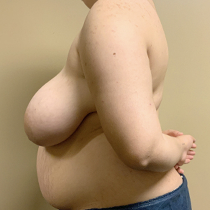 Female To Male Top Surgery 05