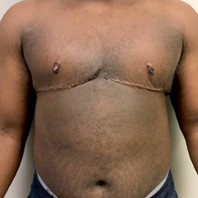 Female To Male Top Surgery 105