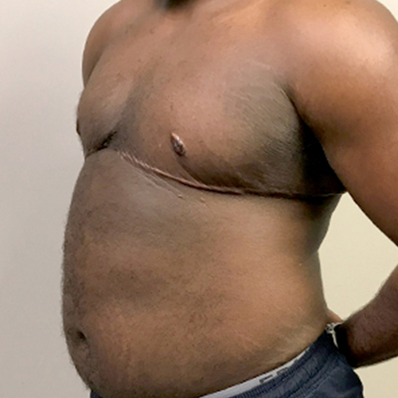 Female To Male Top Surgery 03