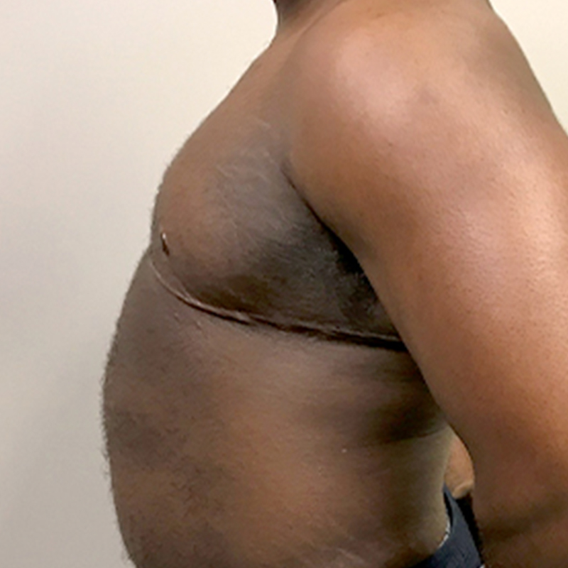 Female To Male Top Surgery 05