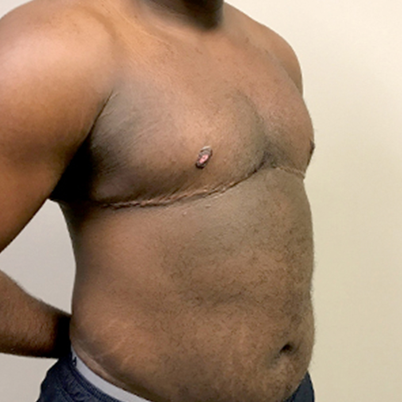 Female To Male Top Surgery 07