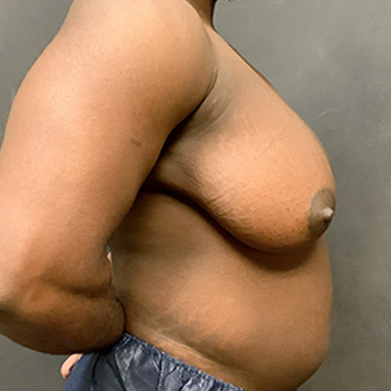 Female To Male Top Surgery 09