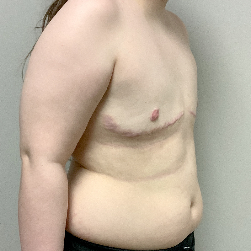 Female To Male Top Surgery 107