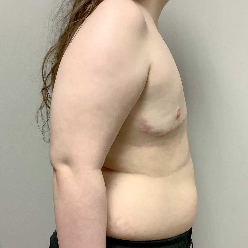 Female To Male Top Surgery 05