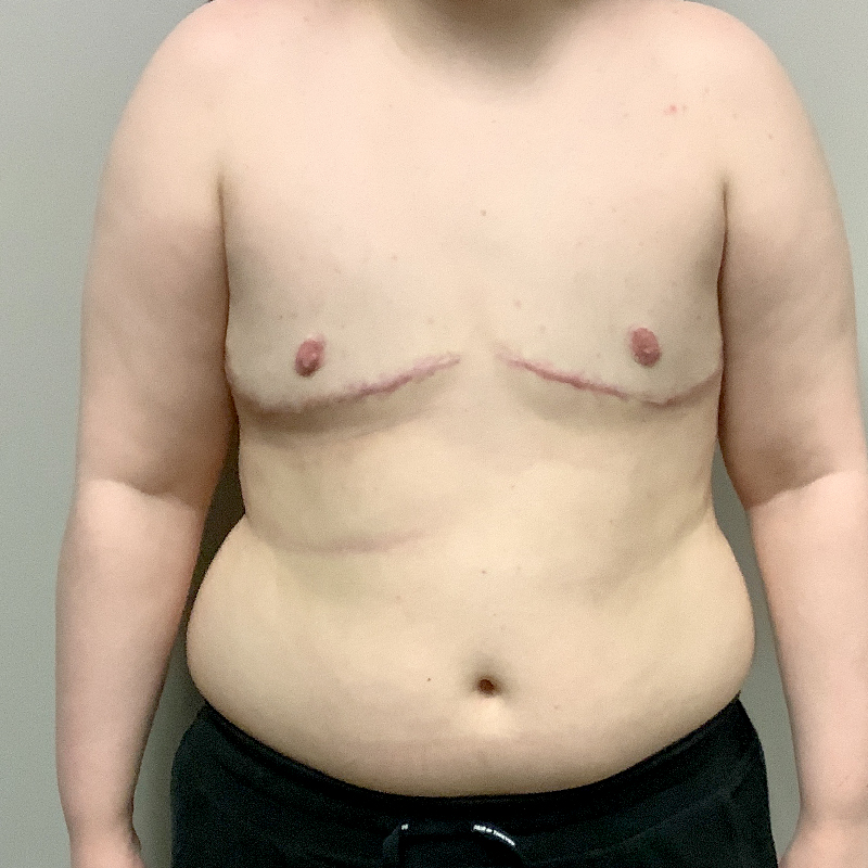 Female To Male Top Surgery 09