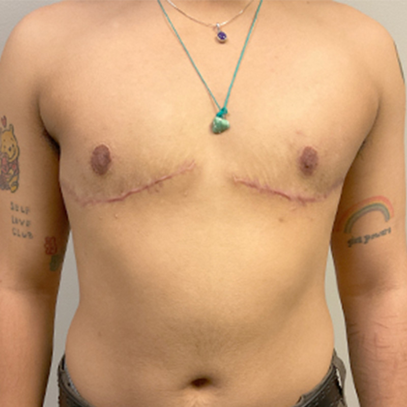 Female To Male Top Surgery 108