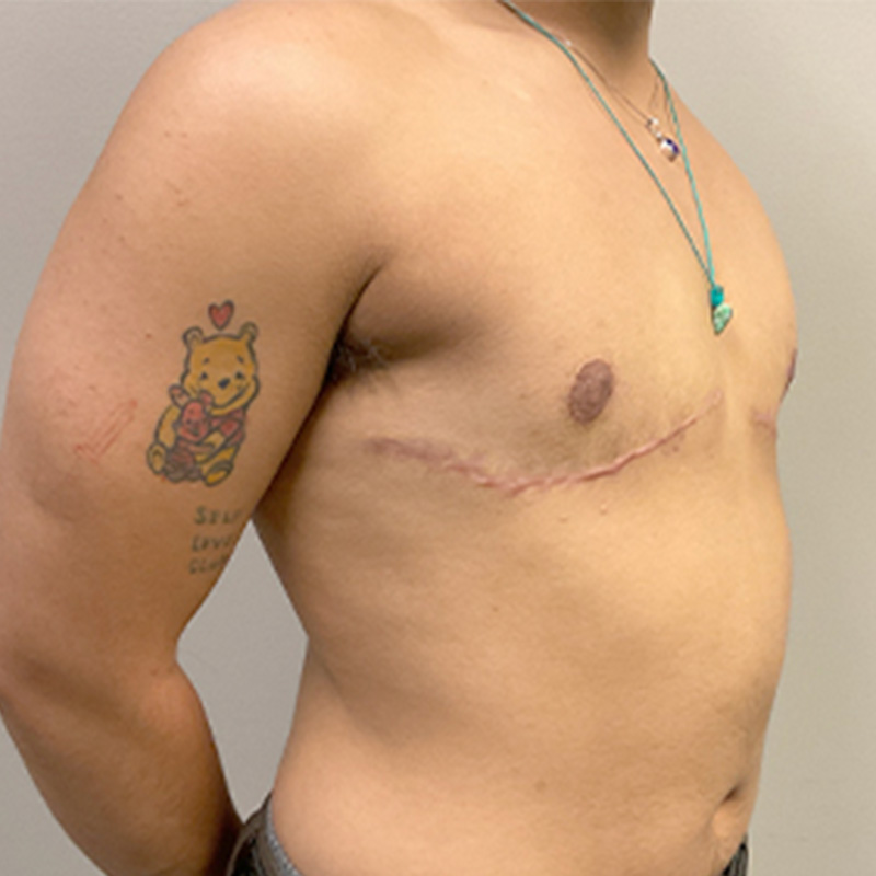 Female To Male Top Surgery 03