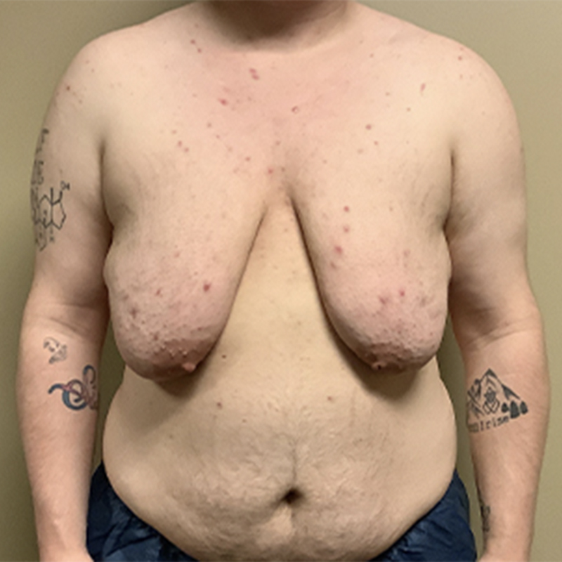 Female To Male Top Surgery 01