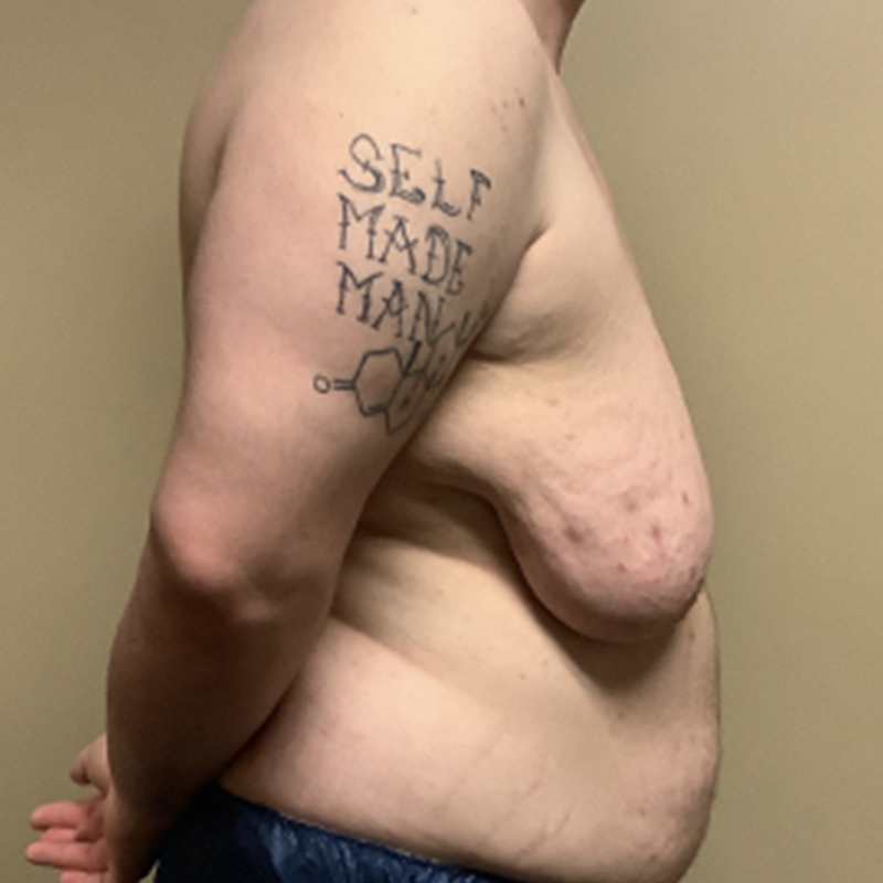 Female To Male Top Surgery 09