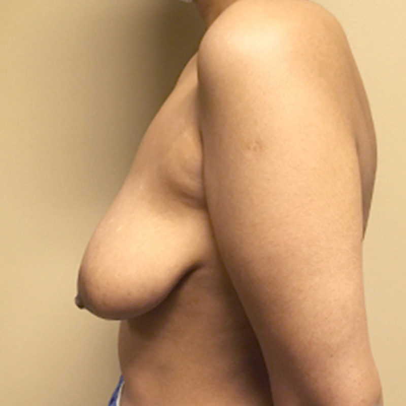 Female To Male Top Surgery 05