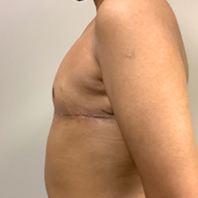 Female To Male Top Surgery 05