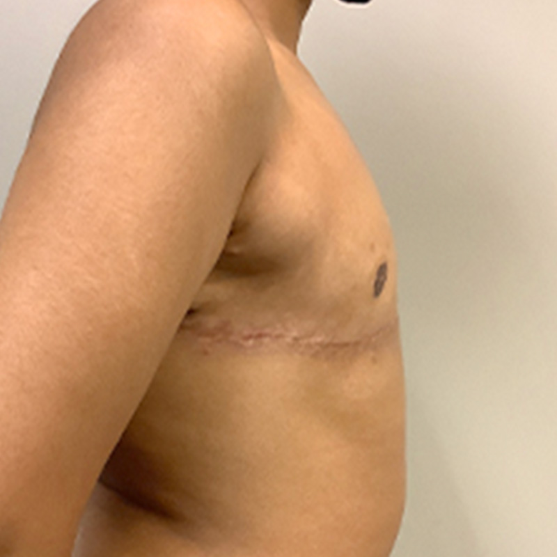 Female To Male Top Surgery 09