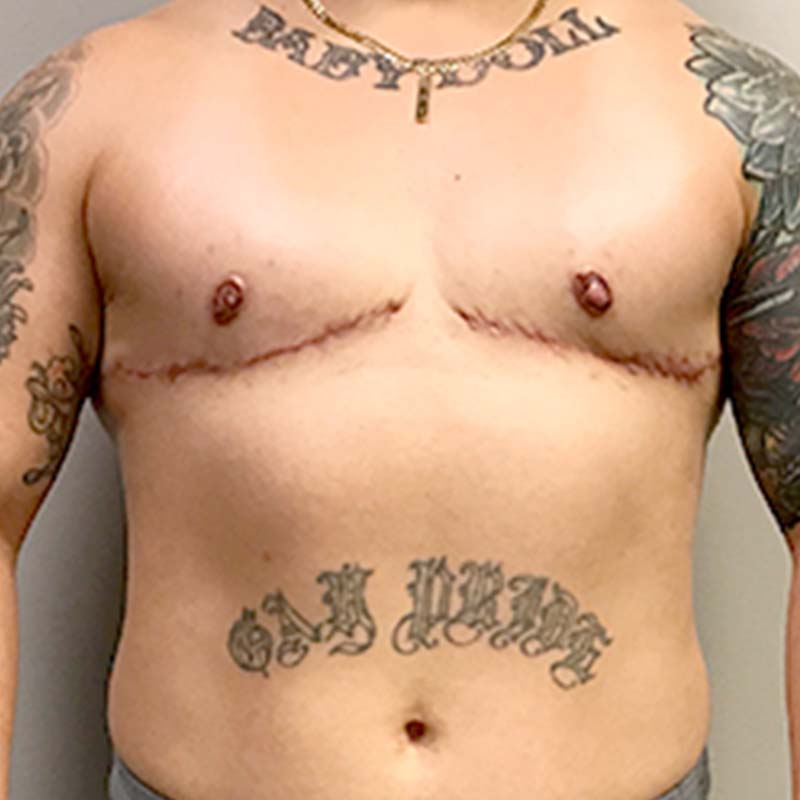 Female To Male Top Surgery 111