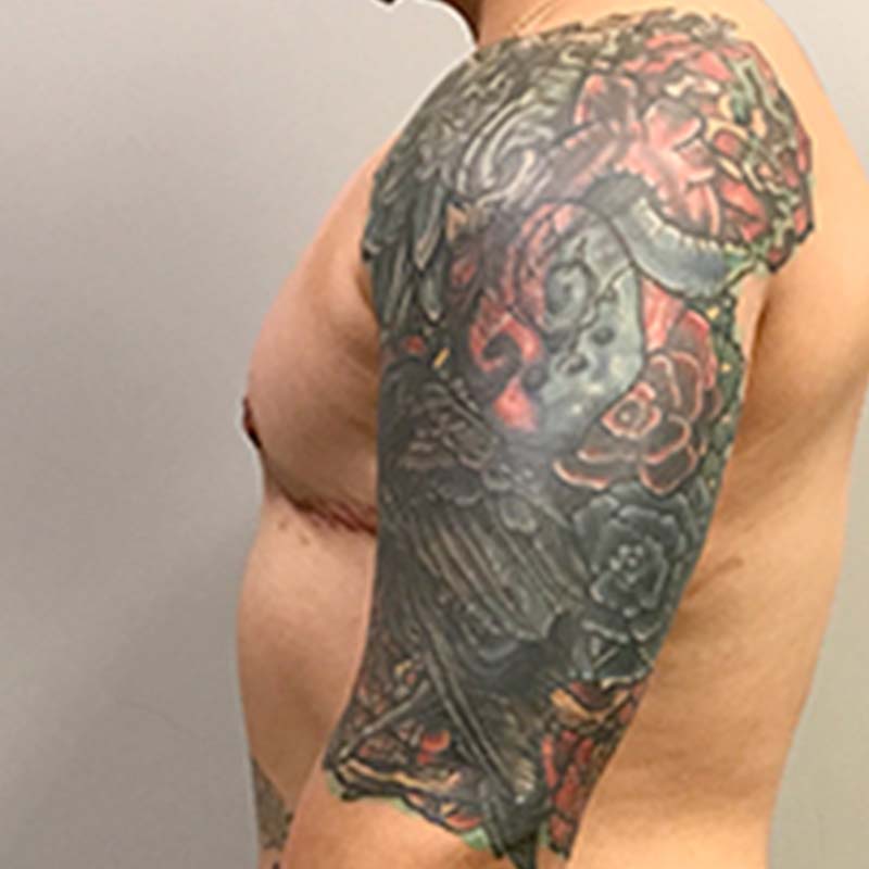 Female To Male Top Surgery 05