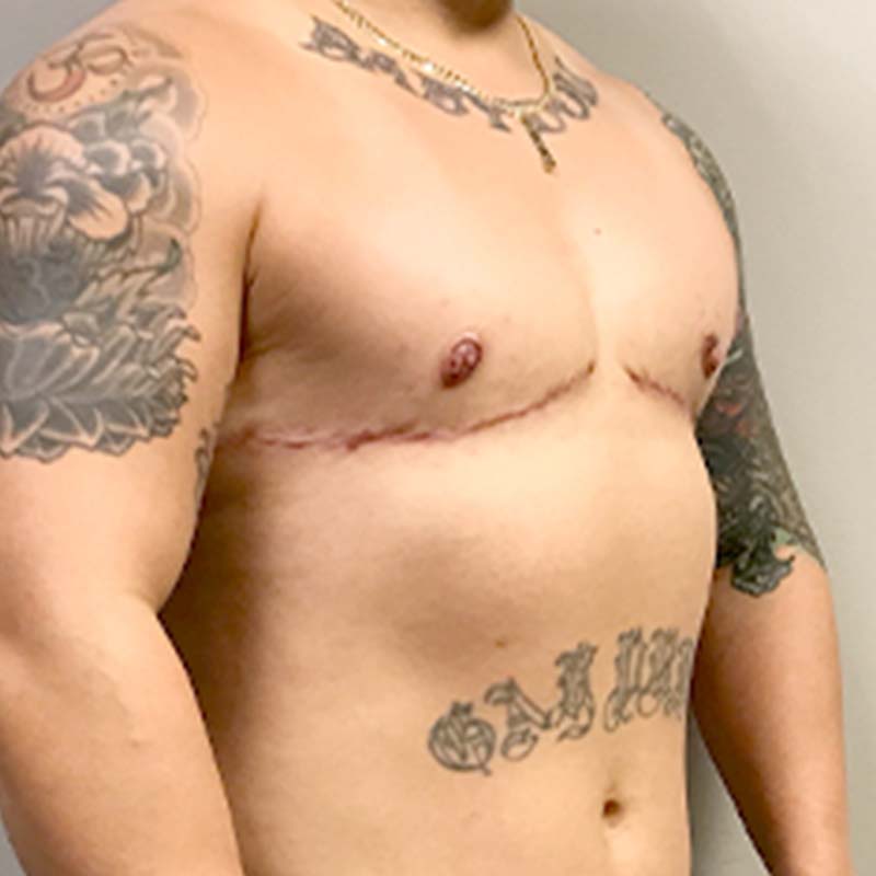 Female To Male Top Surgery 07