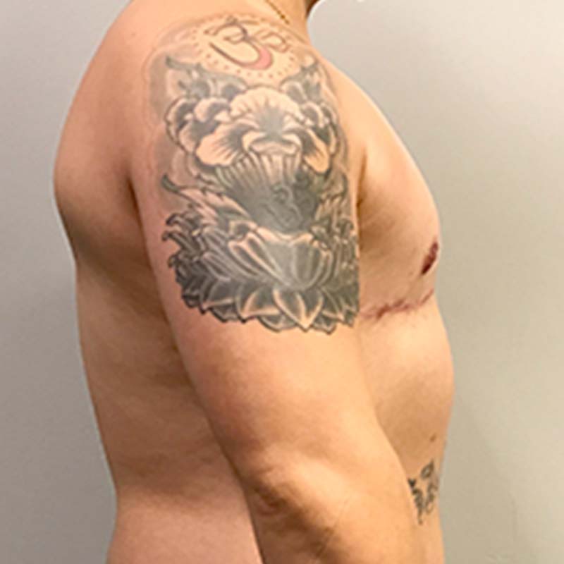 Female To Male Top Surgery 09