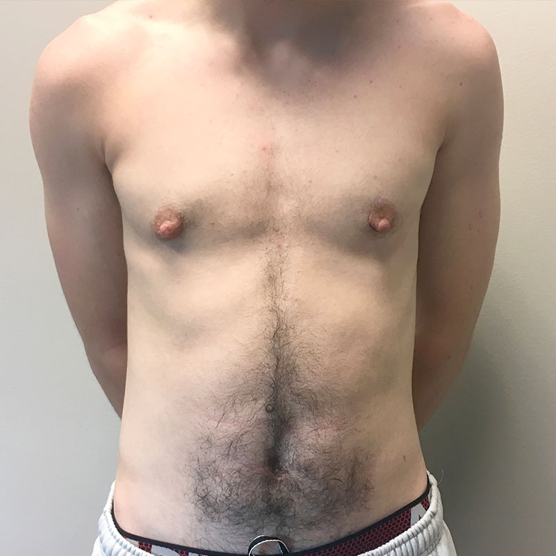 Female To Male Top Surgery 112