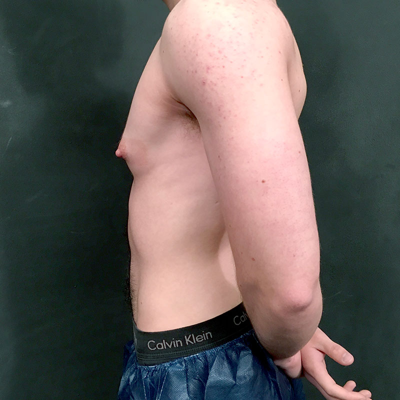 Female To Male Top Surgery 05