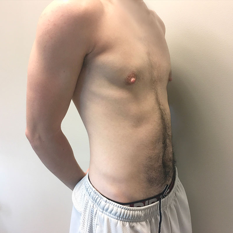 Female To Male Top Surgery 07