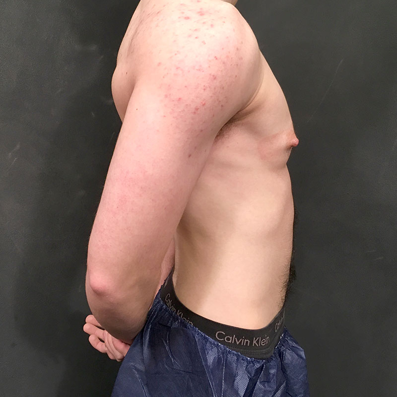 Female To Male Top Surgery 09