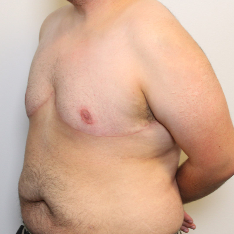 Female To Male Top Surgery 05