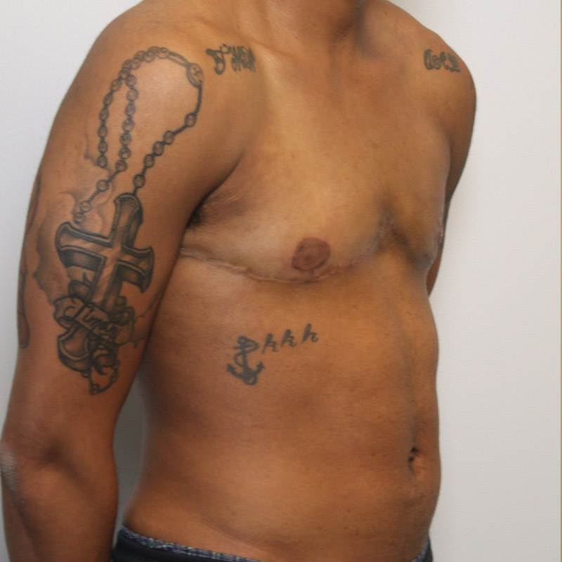 Female To Male Top Surgery 03