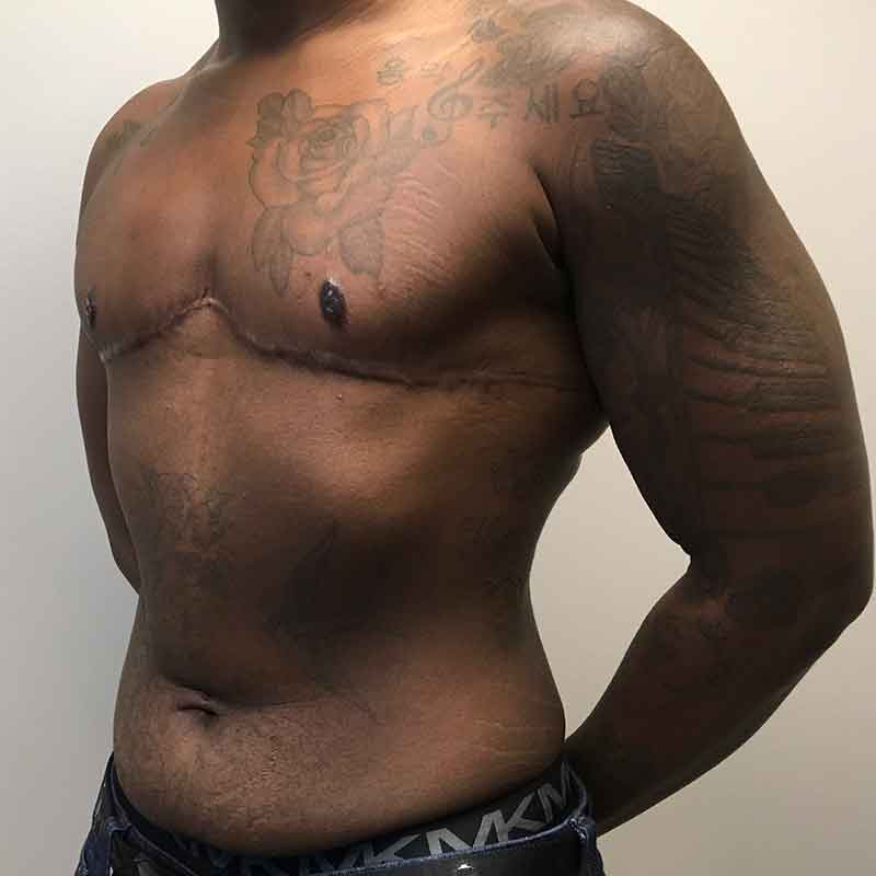 Female To Male Top Surgery 03