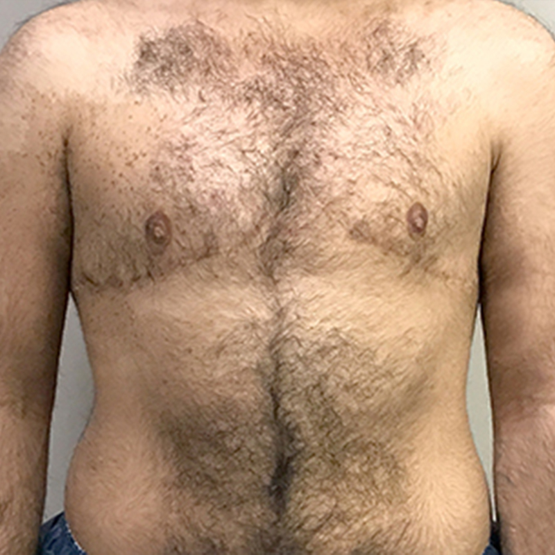 Female To Male Top Surgery 13