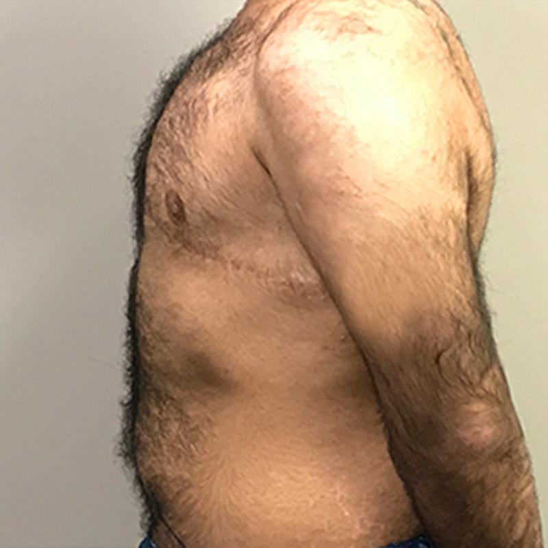 Female To Male Top Surgery 05