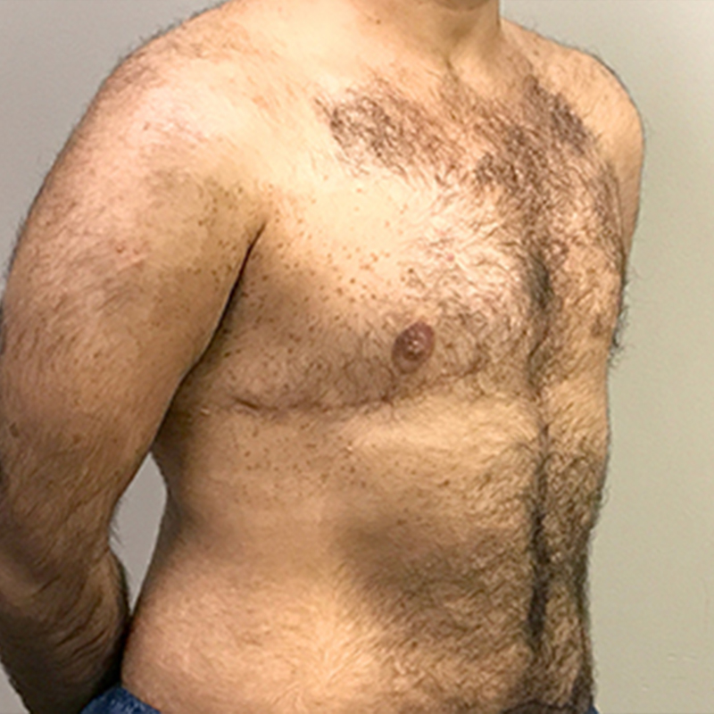 Female To Male Top Surgery 07