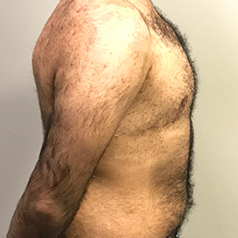 Female To Male Top Surgery 09