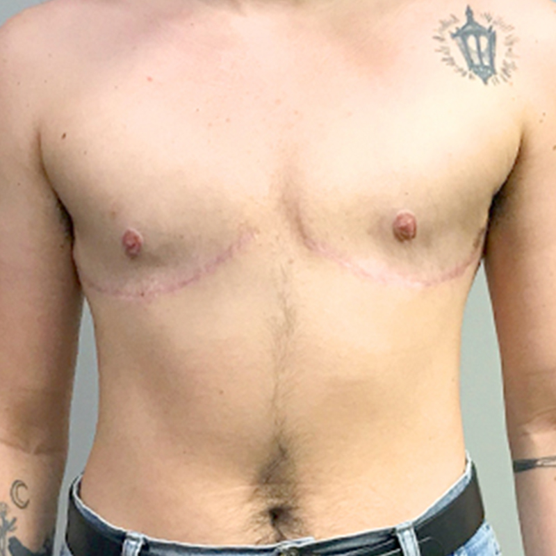 Female To Male Top Surgery 14