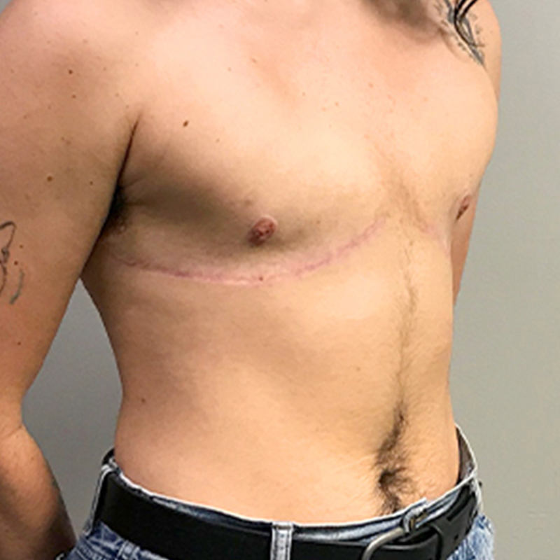 Female To Male Top Surgery 07