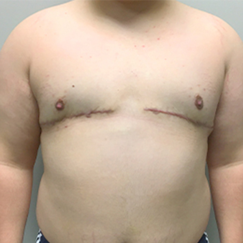 Female To Male Top Surgery 15