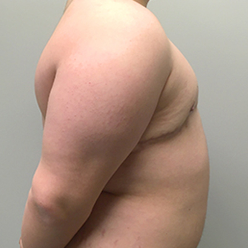 Female To Male Top Surgery 05