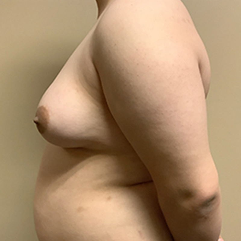 Female To Male Top Surgery 09