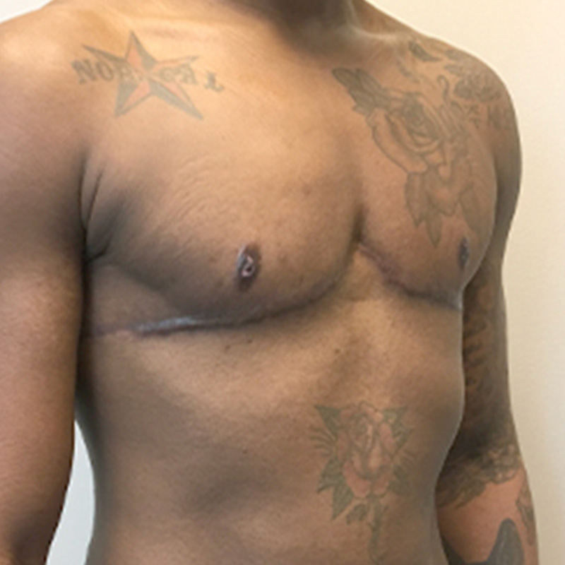 Female To Male Top Surgery 07